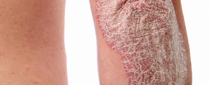 13 Organic skin care tips to help with psoriasis
